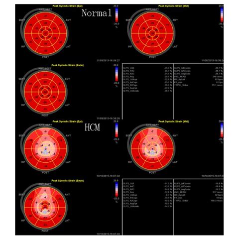 The Bull S Eyes Of The Peak Systolic Longitudinal Strain Of The