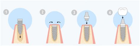 Partes del implante dental y sus cuidados Bukodent Clínica Dental en