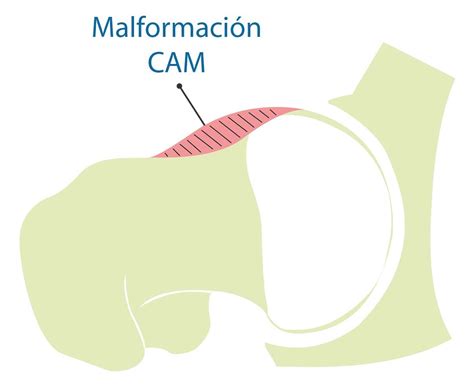 Cirug A Artrosc Pica De Cadera Pincer Y Cam Lima Per