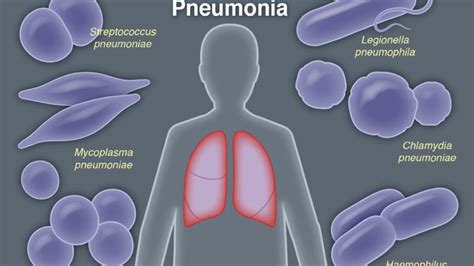 Treating Community Acquired Pneumonia Youtube