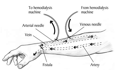 Forearm With An Av Fistula And Tubes Inserted With Labels Media