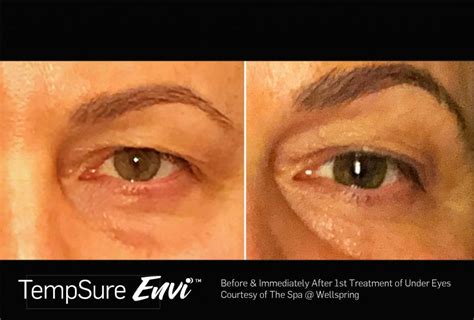 Tempsure Envi Before And After Custom Image Wellspring Updated Jpeg