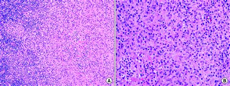 Photomicrograph Shows Chronic Granulomatous Inflammation With