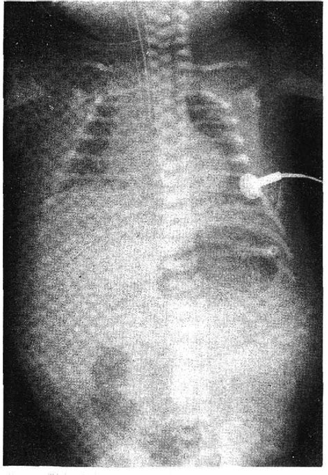 Figure From Ileal Atresia Secondary To Intrauterine Segmental