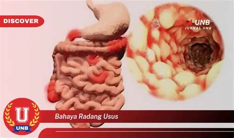 Inilah 10 Bahaya Radang Usus Yang Bikin Penasaran