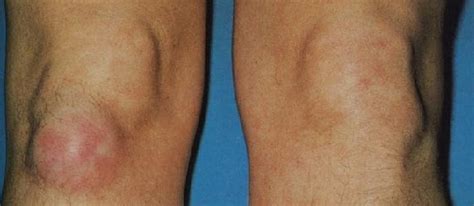 Rodilla Y Cadera Bursitis De Rodilla