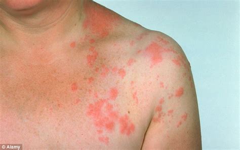 How Shingles In Under 40s Raises The Risk Of A Stroke Or Heart Attack Later On In Life Daily