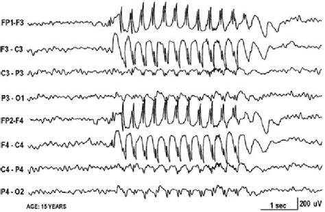 3 Hz Spike Waves During Typical Absence Seizure The Patient Failed To