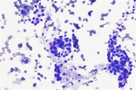 Cytology Fine‐needle Biopsy Of The Neck Mass Download Scientific Diagram