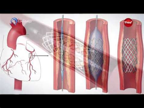 Cateterismo Cardiaco YouTube