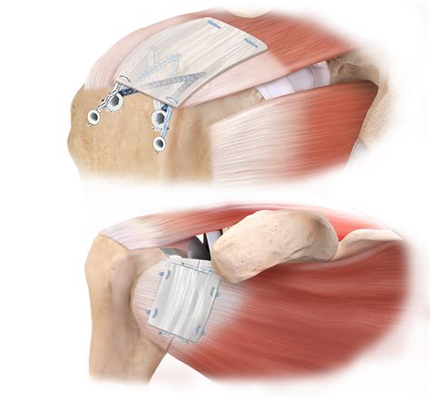 Arthrex Autograft Tissue Compression System