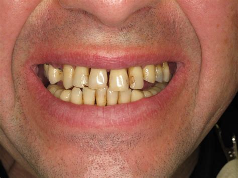 All On 4 Used To Treat Severe Gum Disease Before And After Pictures