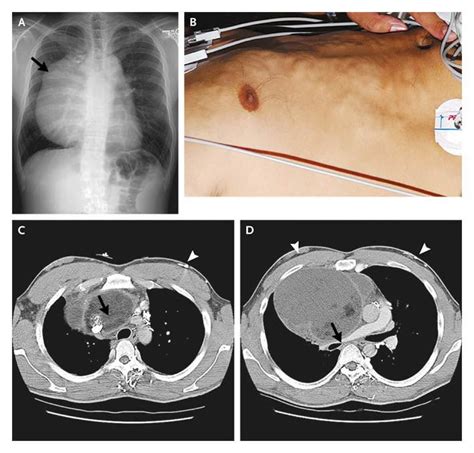 Benign Mediastinal Teratoma New England Journal Of Medicine