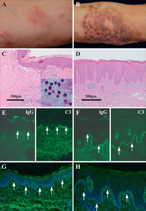 Jle European Journal Of Dermatology The Different Intensity Of Autoantibody Deposits In