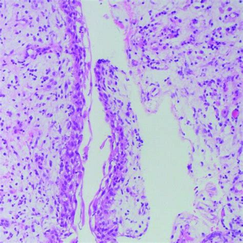 Dentigerous Cyst Hematoxylin And Eosin 200x Histology Revealed An Download Scientific