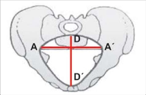 Pelvi ósea Tipo Androide A A Diámetro Transverso D D Diámetro Download Scientific Diagram