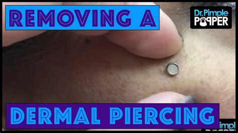 How Much Does It Cost To Remove A Dermal Piercing The Correct