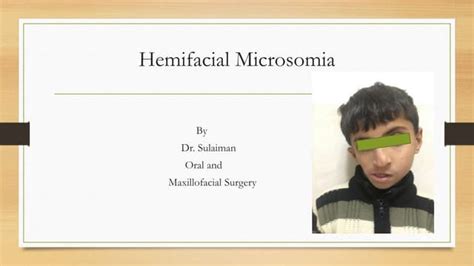 Hemifacial Microsomia Ppt