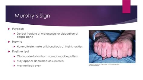 Positive Murphy's Sign Hand : How To Assess For Cholecystitis And Small ...