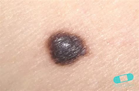 Skin Cancer Quiz Can You Spot The Bad Mole