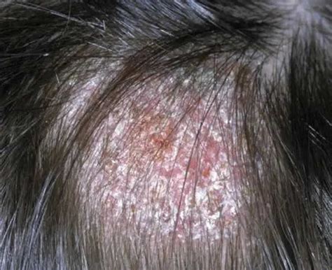 Ringworm Tinea Causes Signs Symptoms Diagnosis Treatment