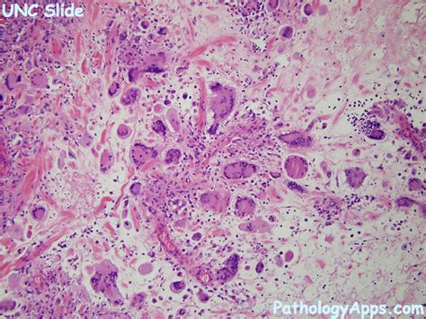 Necrobiotic Xanthogranuloma Histology