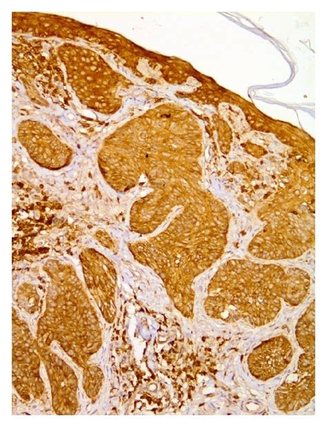 Ezrin Immunoreactivity In Periocular Basal Cell Carcinoma Download Scientific Diagram