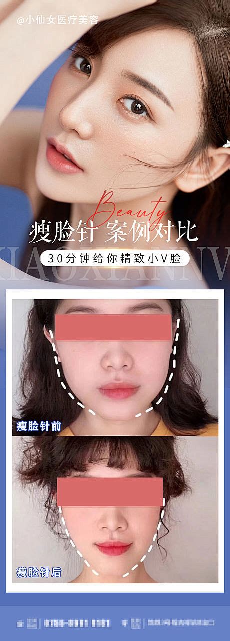 医美微整瘦脸针案例对比海报 源文件