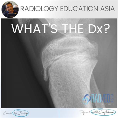 LearningRadiology Osgood-Schlatter Disease, 55% OFF