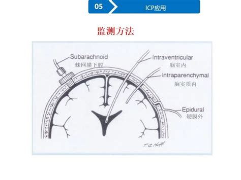 监测有道丨脑血管意外患者的icp（颅内压）探头植入手术与监测——颅脑创伤 神经重症周刊（第227期） 脑医汇 神外资讯 神介资讯