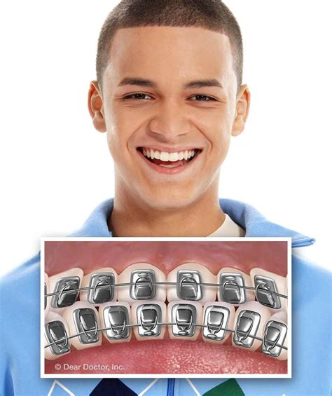 Types Of Braces Mess Orthodontics Columbus Ohio