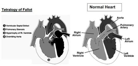 Tetraology Of Fallot Cardiology System Blueprint Smarty Pance