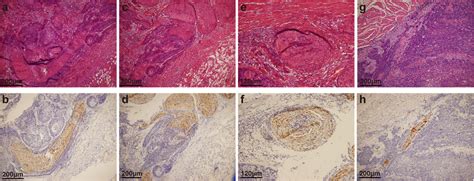 Representative Histological Characteristics Of Pni In Escc Typical