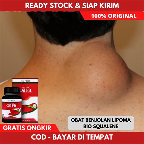 Jual Obat Benjolan Lipoma Obat Benjolan Lemak Tiroid Kelenjar Getah