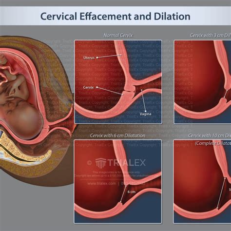 Cervical Effacement And Dilation Trialexhibits Inc