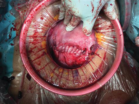 Cesarean Section Technique With Diagram