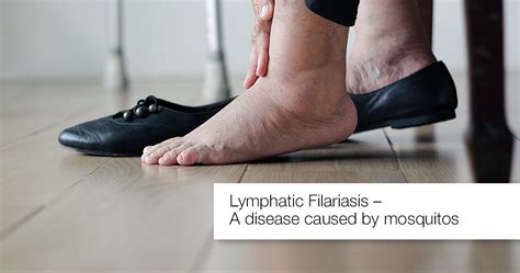 Lymphatic Filariasis Causes Symptoms And Treatment Apollo Hospital