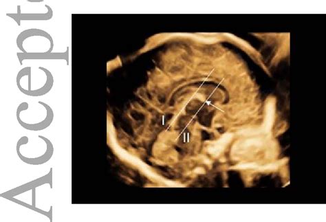 Fetal Biometry Ultrasound