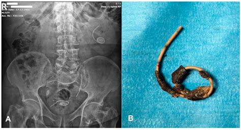 Double J Ureteral Stent