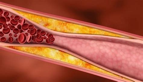 Arteriosclerosis Qué es síntomas causas y tratamiento de la