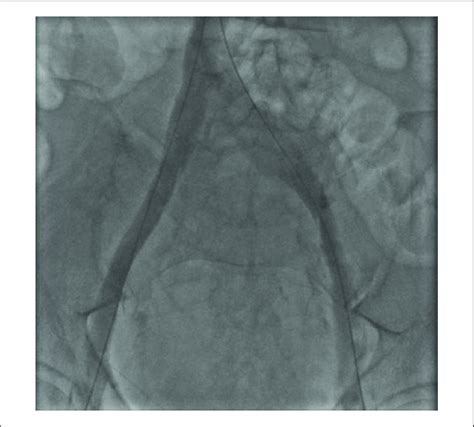 Venogram Of Bilateral Femoral And Iliac Veins After Treatment With