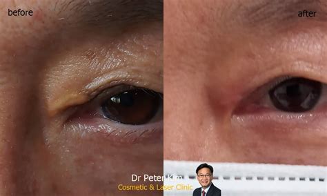 Laser Xanthelasma Removal Dr Peter Kim Surgery Skin Cancer