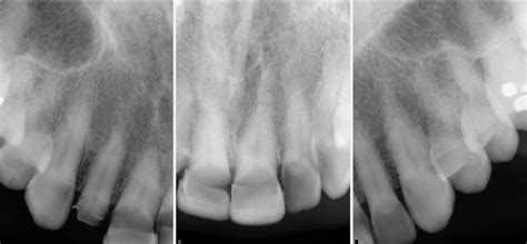 Rehabilitation Of A Patient With Bruxism And Clenching Gps Dental