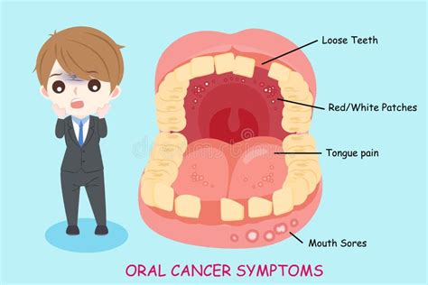 Cancer Tongue Stock Illustrations Cancer Tongue Stock