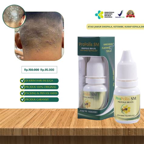 Jual Obat Kurap Jamur Di Kulit Kepala Kulit Kepala Berjamur Kulit