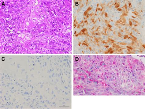 Representative Results Of A Usual Squamous Cell Penile Carcinoma With Download Scientific