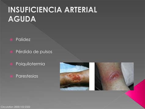 Ppt Insuficiencia Arterial Venosa Powerpoint Presentation Free