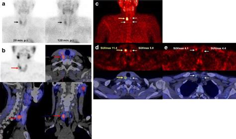 Mtc Mibi Planar Scintigraphy Images A Mtc Mibi Spect Ct Images