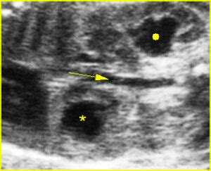 Hydronephrosis Department Of Obstetrics And Gynecology Faculty Of