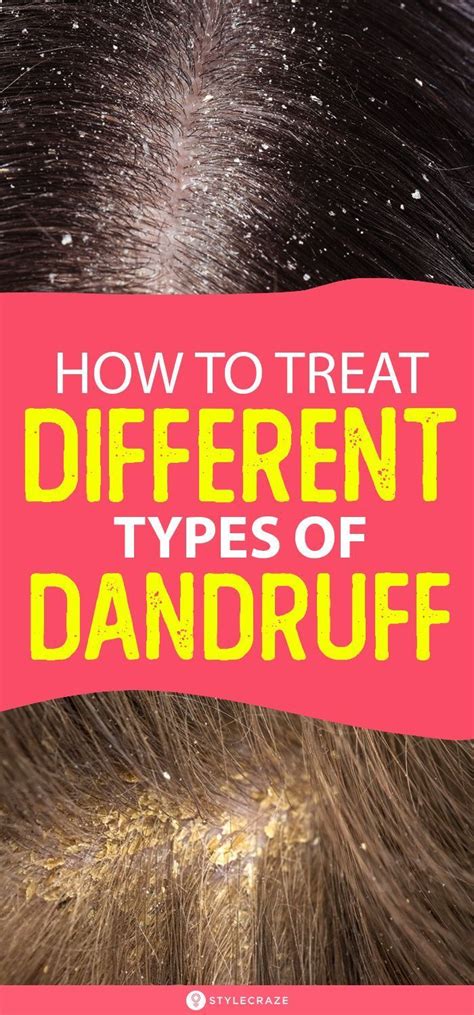 Different Types Of Dandruff And How To Stop Them Artofit